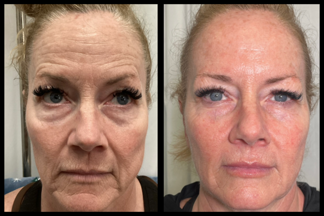 Botox before and after results, Slender Me Medical Corona CA