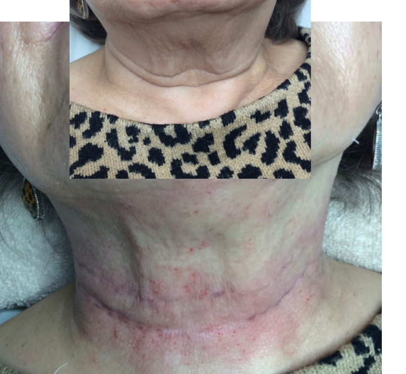 Tech neck line treatment at Slender Me Medical in Corona, CA
